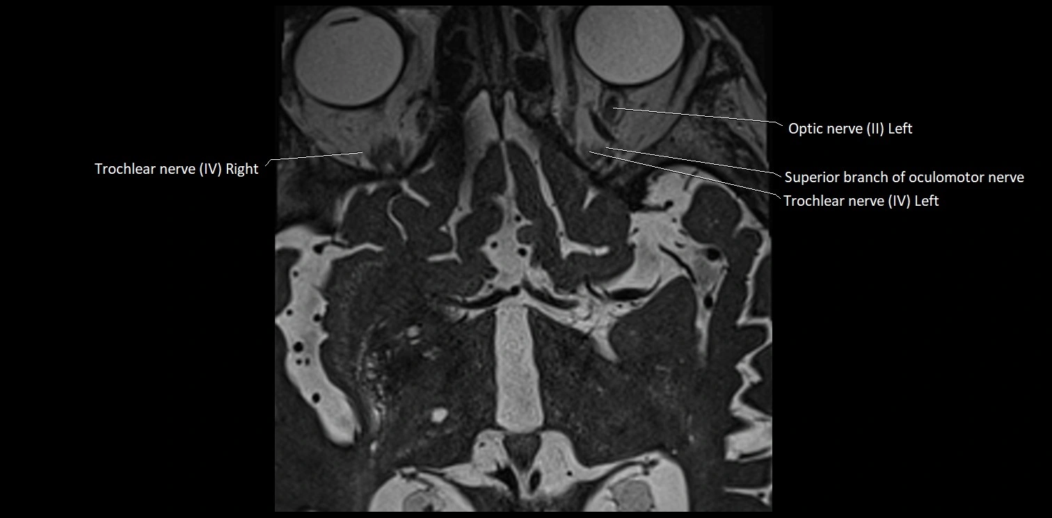 Cranial nerve anatomy axial MRI 3T image 3.webp